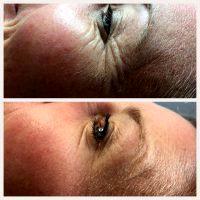 Does Botox Remove Crow's Feet Wrinkles