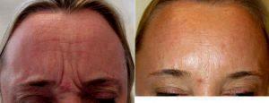 Dr Benjamin Barankin, MD, FRCPC, Toronto Dermatologic Surgeon - 54 Year-old Female Treated With Botox For Frown Lines