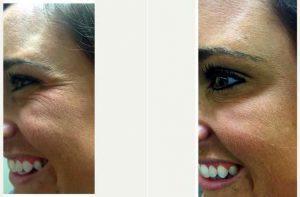 Dr Byron A. Long, MD, Marietta Oculoplastic Surgeon - 32 Year Old Woman Treated With Botox Around Eyes