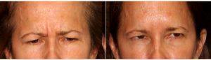 Dr Douglas Wu, MD, San Diego Dermatologist - 45 Year Old Woman Treated With Botox 11 Lines