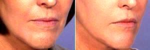 Dr Grant Stevens, MD, Los Angeles Plastic Surgeon - Botox And Juvederm Ultra Plus To Upper Lip