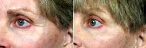 Dr Grant Stevens, MD, Los Angeles Plastic Surgeon - Botox For Crows Feet