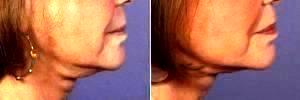 Dr Grant Stevens, MD, Los Angeles Plastic Surgeon - Botox To Neck (Platysmal Band Muscles)