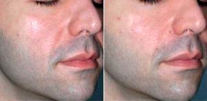 Dr Jason Emer, MD, Los Angeles Dermatologic Surgeon - Young Male Treated For Nasolabial Folds And Cheek Volume
