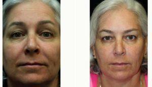 Dr Kris M. Reddy, MD, FACS, West Palm Beach Plastic Surgeon - 54 Year Old Woman Treated With Preventative Botox