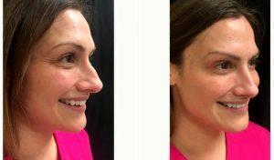 Dr Michele S. Green, MD, New York Dermatologist - 44 Year Old Woman Treated With Botox Crows Feet
