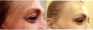 Dr MyChi Le, MD, Saint Joseph Plastic Surgeon - 36 Year Old Woman Treated With Botox Crows Feet