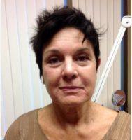 Dr Patricia Faraz, MD, Ladera Ranch OB-GYN - 66 Year Old Woman Treated With Botox