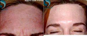 Dr Ronald Shelton, MD, Manhattan Dermatologic Surgeon - 50 Year Old Woman Treated With Botox 11 Lines