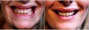 Dr Rupert Critchley, MD, MRCGP, London Physician - 31 Year Old Woman Treated With Botox To Correct Gummy Smile