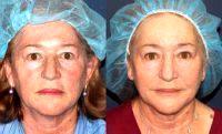 Dr Sabrina Fabi, MD, San Diego Dermatologic Surgeon - 74 Year Old Woman Treated With Botox