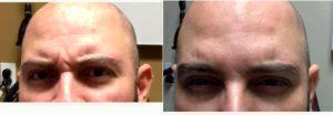 Dr Shaun C. Desai, MD, Bethesda Facial Plastic Surgeon - 35 Year Old Man Treated With Botox 11 Lines