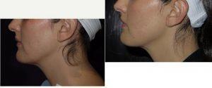 Dr Sheena Kong, MD, San Francisco Internist - 41 Year Old Woman Treated With Botox