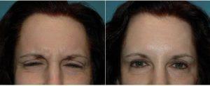 Dr Tracy Leong, MD, Carlsbad Dermatologic Surgeon - 64 Year Old Woman Treated With Botox 11 Lines
