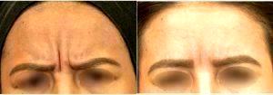 Dr. Alex Eshaghian, MD, PhD, Encino Physician - 30 Year Old Woman Treated With Botox 11 Lines