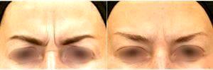 Dr. Alex Eshaghian, MD, PhD, Encino Physician - 40 Year Old Woman Treated With Botox 11 Lines
