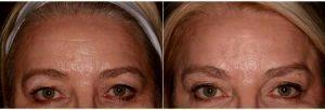 Dr. Andrea Hui, MD, San Francisco Dermatologic Surgeon - Botox And Belotero For Eye Lift And Forehead Lines