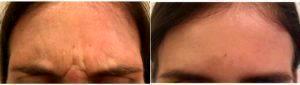 Dr. Daniel Butz, MD, Brookfield Physician - 25 Year Old Woman Treated With Botox 11 Lines