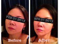 Dr. Daniela Dadurian, West Palm Beach Plastic Surgeon Botox Injection Treatment Before And After