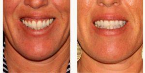 Dr. Douglas Wu, MD, San Diego Dermatologist - 39 Year Old Female Treated With Botox For Gummy Smile