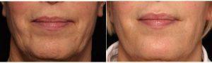 Dr. Gary D. Breslow, MD, FACS, Paramus Plastic Surgeon - 68 Year Old Woman Treated With Botox