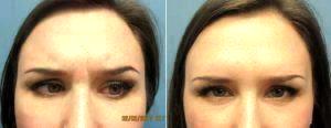Dr. Gregory Baum, MD, Syracuse Plastic Surgeon - 30 Year Old Woman Treated With Botox 11 Lines