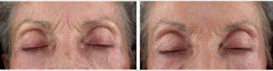 Dr. Greta McLaren, MD, Greenwood Village Physician - 72 Woman Treated With Botox 11 Lines