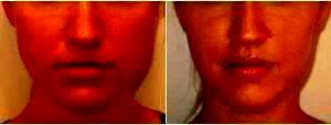 Dr. Houtan Chaboki, MD, Washington DC Facial Plastic Surgeon - 29 Year Old Woman Treated With Botox