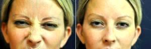 Dr. Jennifer Reichel, MD, Seattle Dermatologist - Botox 11 Lines