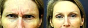 Dr. Jennifer Reichel, MD, Seattle Dermatologist - Botox For 11 Lines