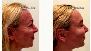 Dr. John Mesa, MD, New York Plastic Surgeon - 39 Year Old Woman Treated With Botox For Crow's Feet Wrinkles