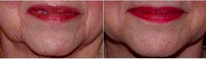 Dr. Karol A. Gutowski, MD, FACS, Chicago Plastic Surgeon - 74 Year Old Woman Treated With Voluma For Marionette Lines Results