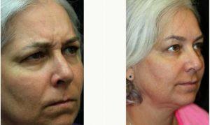 Dr. Kris M. Reddy, MD, FACS, West Palm Beach Plastic Surgeon - 50 Year Old Woman Treated With Botox