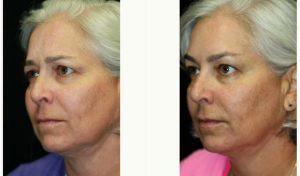 Dr. Kris M. Reddy, MD, FACS, West Palm Beach Plastic Surgeon - 50 Year Old Woman Treated With Botox Frown Lines