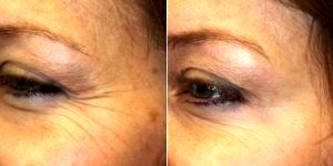 Dr. Laura Phan, MD, Los Gatos Physician - 46 Year Old Woman Treated With Botox