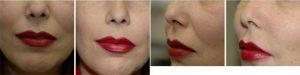 Dr. Lawrence Kass, MD, Saint Petersburg Oculoplastic Surgeon - 49 Year Old Woman Treated With Juvederm To Nasolabial Folds