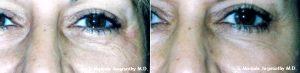 Dr. Manjula Jegasothy, MD, Miami Dermatologist - 68 Year Old Woman Treated For Crow's Feet With Botox