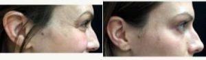 Dr. Michele S. Green, MD, New York Dermatologist - 29 Year Old Woman Treated With Botox For The Crow's Feet