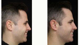 Dr. Michele S. Green, MD, New York Dermatologist - 32 Year Old Man Treated With Botox Crows Feet