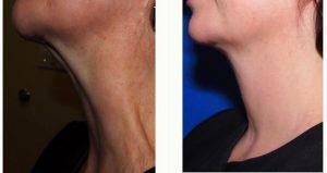 Dr. Myriam Loyo, MD, Portland Facial Plastic Surgeon - Neck Bands Softened With Botox In Neck Bands