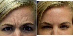 Dr. Peter N. Butler, MD, Pensacola Plastic Surgeon - 30 Year Old Woman Treated With Botox 11 Lines