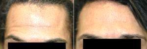 Dysport (Botox) For Deep Forehead Wrinkles In Male Patient With Dr. Harold J. Kaplan, MD, Los Angeles Facial Plastic Surgeon