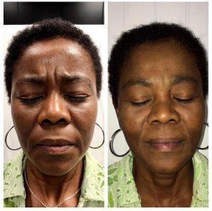 Dysport In Between The Brows, And Restylane Lyft Was Used For The Cheekbones To Help Decrease Smile Lines At National Laser Institute Med Spa, Scottsdale, AZ