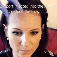 Dysport Injected Into The Glabella To Reduce Frown Lines