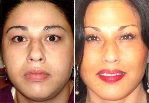 Eliminate Deep Lines On Her Forehead And Around Her Eyes By Dr. Emilio Justo