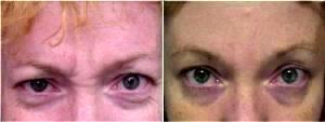 Facial Rejuvenation (Botox for 11 lines) Before & After With Doctor Michael Stefan, MD, Baltimore Plastic Surgeon