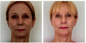 Facial Rejuvenation Using Dermal Fillers By Anusha H. Dahanayake, NP, Doctor In Los Angeles, California