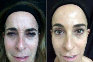 Female Treated With Botox 11 Lines In Forehead And Crows Feet Before & After With Doctor Michele S. Green, MD, New York Dermatologist