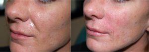Filler By Dr. Larry Pollack, MD, San Diego CA Plastic Surgeon