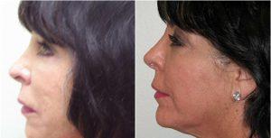 Fillers By Dr. Andre Berger, MD, Beverly Hills CA Physician